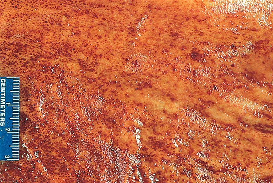 A close shot of a section of an inflamed stomach characterized by lesions in mucous membranes measuring 3 centimeters.