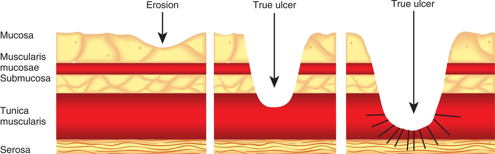 Three illustrations depict lesions by peptic ulcer disease, which show the layers of the stomach labeled mucosa, muscularis mucosae, submucosa, tunica muscularis, and serosa. The first illustration depicts erosion where the lesion occurs in the mucosa. The second illustration depicts the true ulcer where the lesion extends to tunica muscularis. The third illustration depicts the true ulcer where the lesion extends to the serosa.