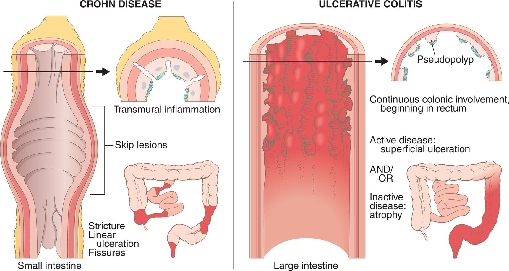 The illustration on the left depicts the distribution pattern of Crohn's disease, which shows the sectional view of the small intestine with labels indicating the skip lesion, stricture, linear ulceration, and fissures accompanied by the illustrations of a horizontal sectional view small intestine indicating the transmural inflammation. The illustration on the right depicts the distribution pattern of ulcerative colitis with labels indicating continuous colonic involvement, beginning in rectum; active disease: superficial ulceration; and or inactive disease: atrophy accompanied by the horizontal section of the large intestine indicating the pseudopolyp.