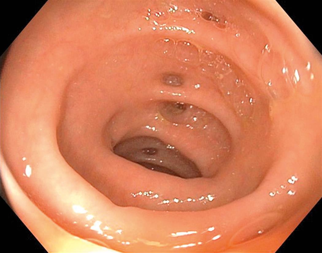 A close shot of the endoscopic image shows diverticular lesions along the distal descending colon.