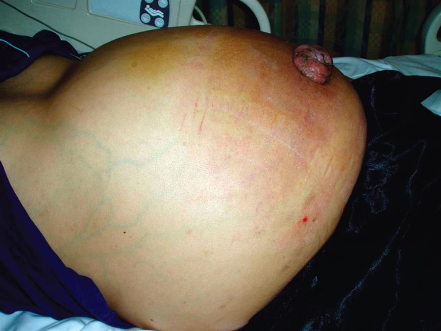 A close shot of the distended abdomen of a person lying on his back.
