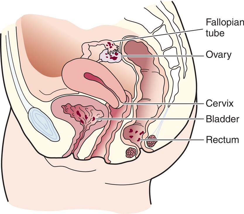Illustration of lateral view of male pelvis shows labels for structures from top to bottom as follows: Fallopian tube, ovary, cervix, bladder, and rectum.