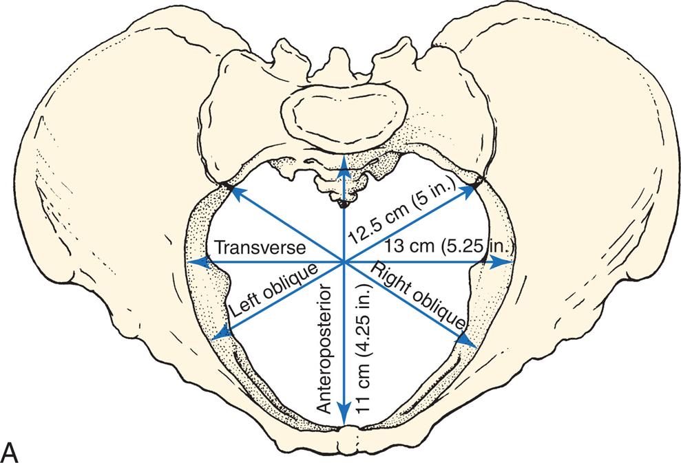 A) Illustration of pelvic girdle shows pelvic inlet diameters including anteroposterior 11 centimeters (4.25 inches), transverse 13 centimeters (5.25 inches), and the right and left 12.5 centimeters (5 inches) oblique diameters. B) Illustration of fetal skull shows measurements of the fetal skull as follows: Submentobregmatic (face) 9.5 centimeters, Verticomental (brow) 13.5 centimeters, Occipitofrontal (vertex, military) 11.0 centimeters, and Suboccipitobregmatic (vertex, flexed) 9.5 centimeters.