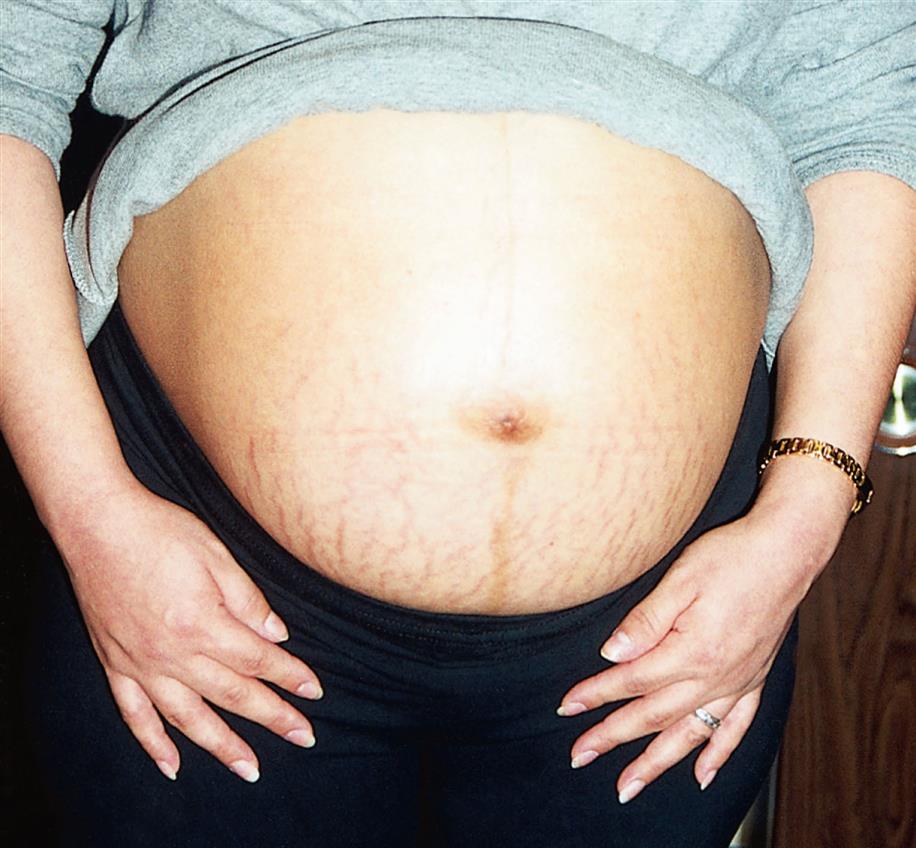 A close-up of abdomen of a patient with t-shirt rolled up shows pinkish white or purple-gray lines arising from pubic symphysis towards the navel.