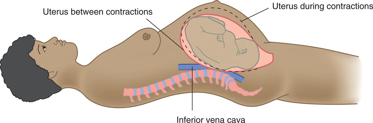 Illustration of a woman lying in supine shows position of uterus between contractions and during contractions pressing above inferior vena cava.