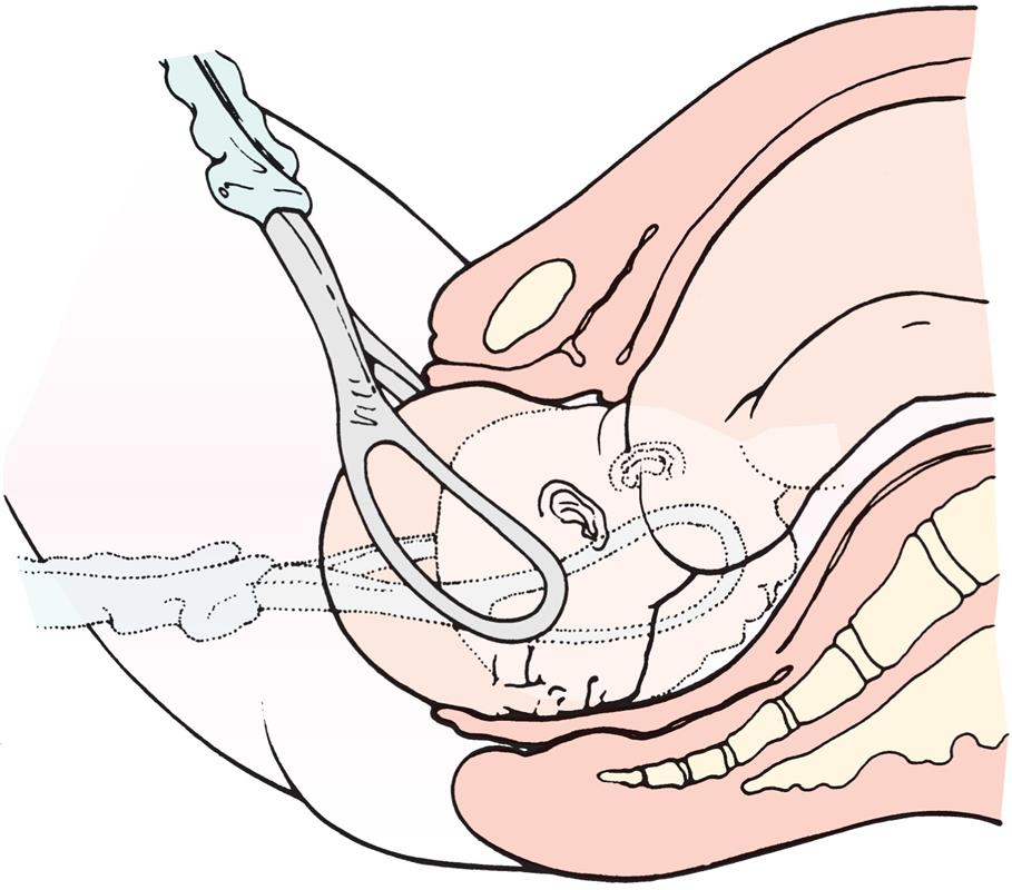 Illustration shows head of baby being pulled using forceps and two blades from the birth canal.