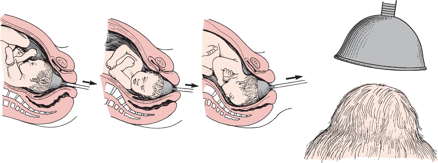 Illustration shows three steps of baby being coming outside, indicated by rightward arrows, from the birth canal using vacuum extractor. To the right, vacuum cup and head of baby are illustrated.