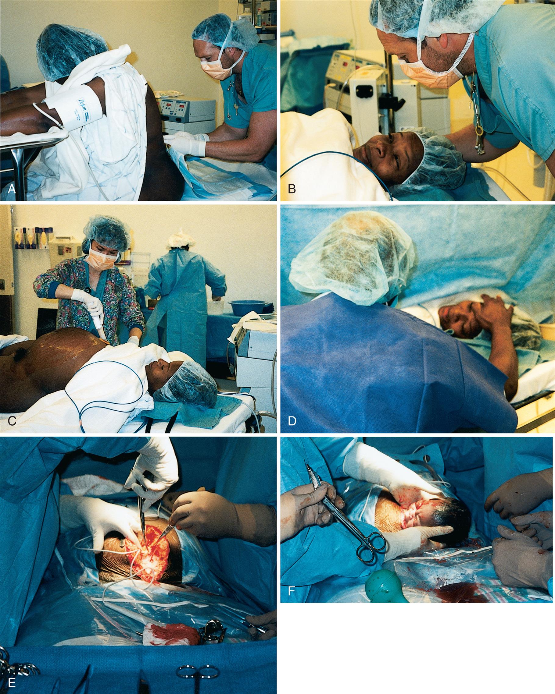 Six close-up views marked A through F shows step involved in delivering a baby through Cesarean section. A) Side view of a nurse with gloved hands inserting a needle at the lower back of woman. B) The woman is lying supine with frightened expressions. A nurse is talking to the woman. C) A nurse starts a cut on the abdomen of woman. D) Nurse places hand on the forehead of woman. E) Nurses with gloved hands cut the abdomen of woman. F) Head of the baby is outside the abdomen of woman." "Four close-up views marked G through J shows step involved in delivering a baby through Cesarean section. G) Nurses with gloved hands gently pull the baby from uterus. H) Baby is outside the uterus. Tip of bulb syringe is inserted into the nostril of baby by a gloved hand. I) Assortment of various equipments used during and after the delivery along with cotton. J) Nurse brings the newborn near mother.