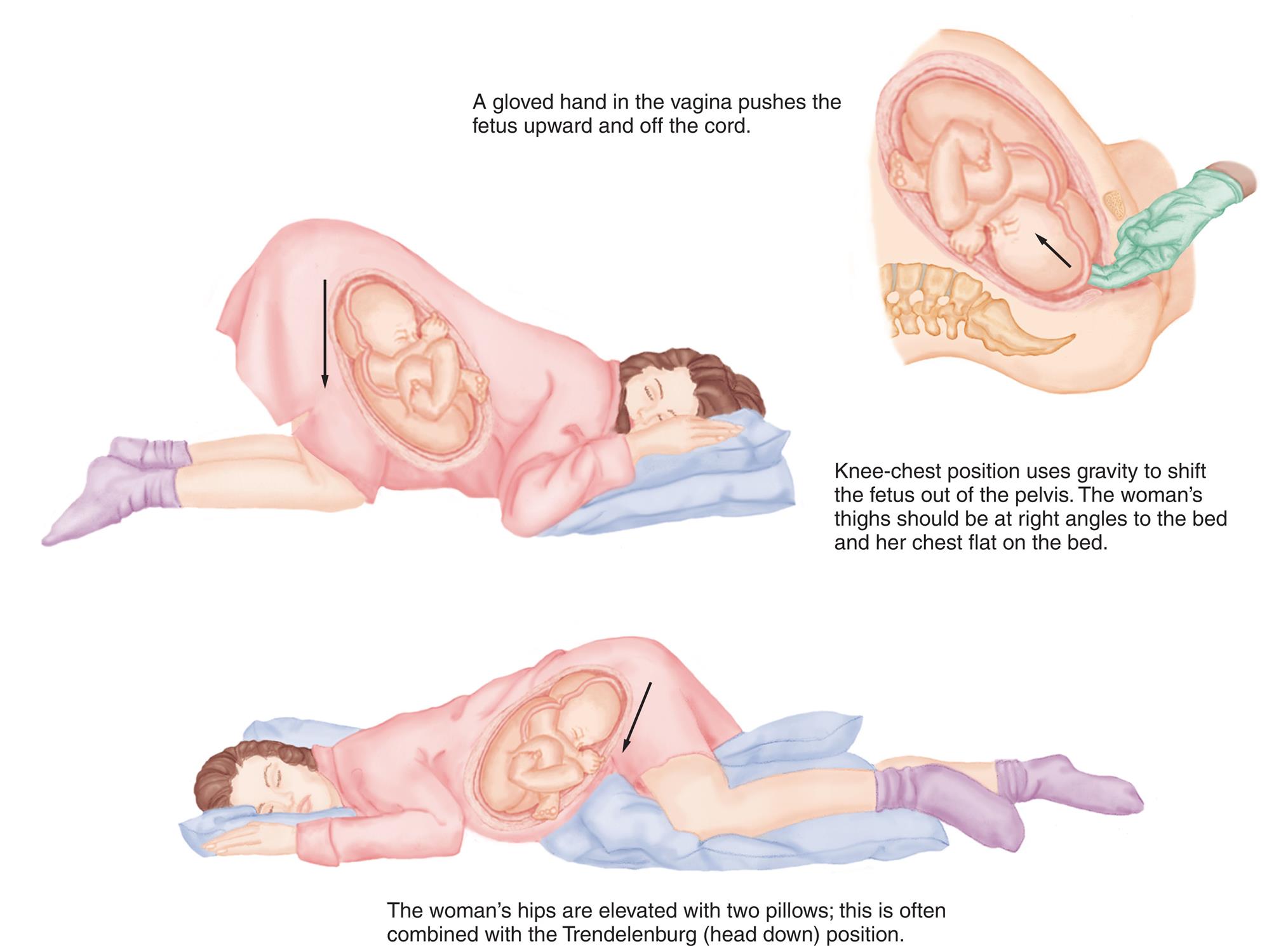 Three illustration show different positions of pregnant woman. In the first illustration, a gloved hand in the vagina pushes the fetus upward and off the cord, indicated by a slant, upward arrow. In the second illustration, knee-chest position uses gravity to shift the fetus out of the pelvis. The woman’s thighs should be at right angles to the bed and her chest flat on the bed, indicated by a downward arrow. In the third illustration, the woman’s hips are elevated with two pillows; this is often combined with the Trendelenburg (head down) position, indicated by a slant, downward arrow.