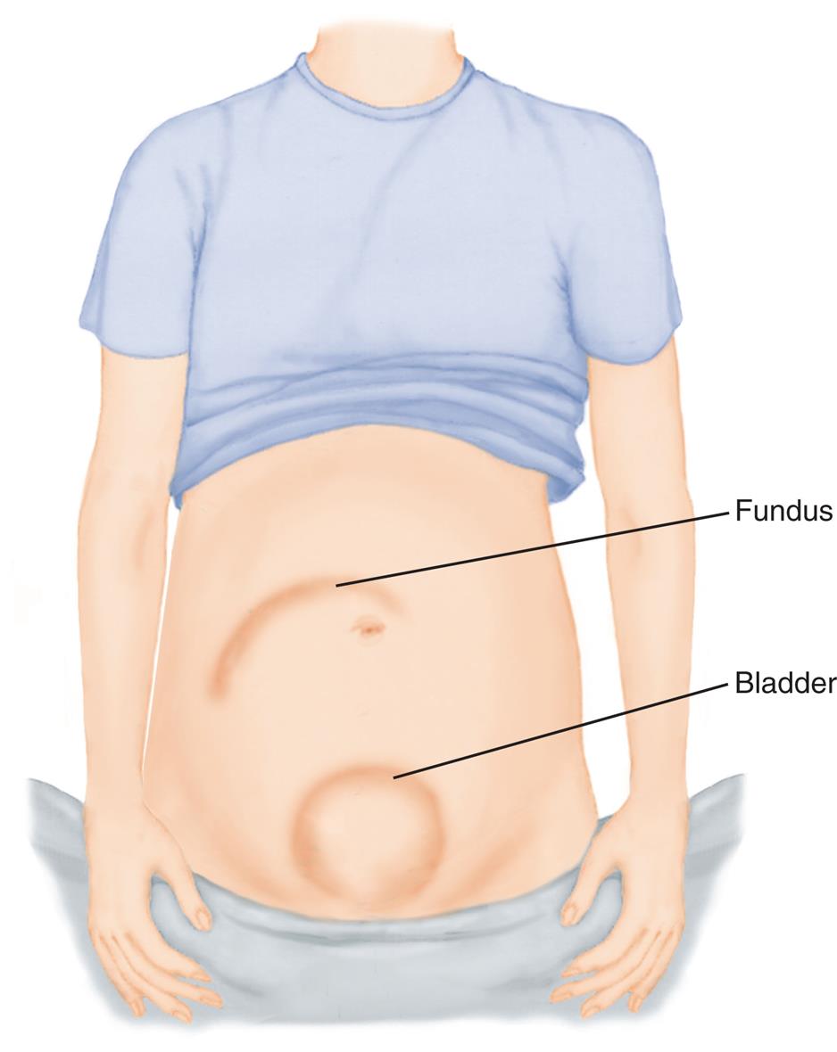 Illustration of woman shows a curved line on the abdomen marked fundus and swelled bladder.