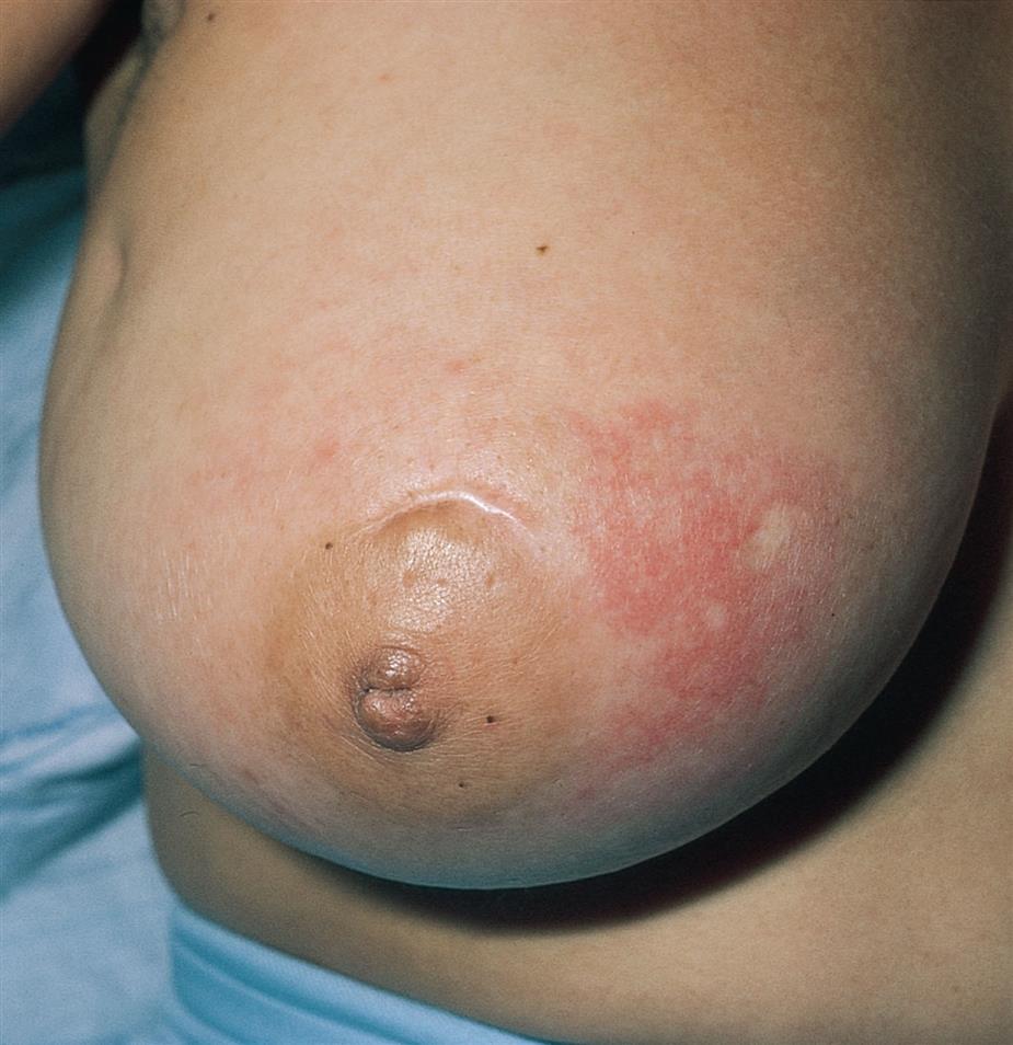 Close-up of breast shows inflammation of tissue and redness near areola.