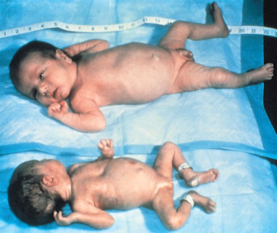 Close-up of two newborn twins with significant different in height and weight. There is an inch tape on one side of newborns.