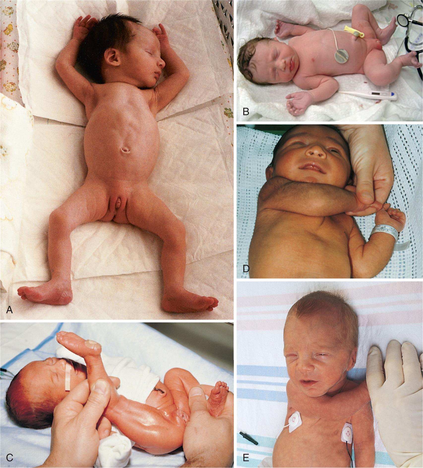 A) Close-up of prematured baby lying supine with arms up and legs wide. B) Close-up of a healthy baby with knees and elbows flexed. C) Close-up of a hand bringing heel of newborn above the face. D) Close-up of a hand bringing right arm of newborn to left shoulder. The newborn wears an identification band. E) Close-up of newborn with electrodes attached to the chest. A gloved hand pulls right arm of newborn to one side.