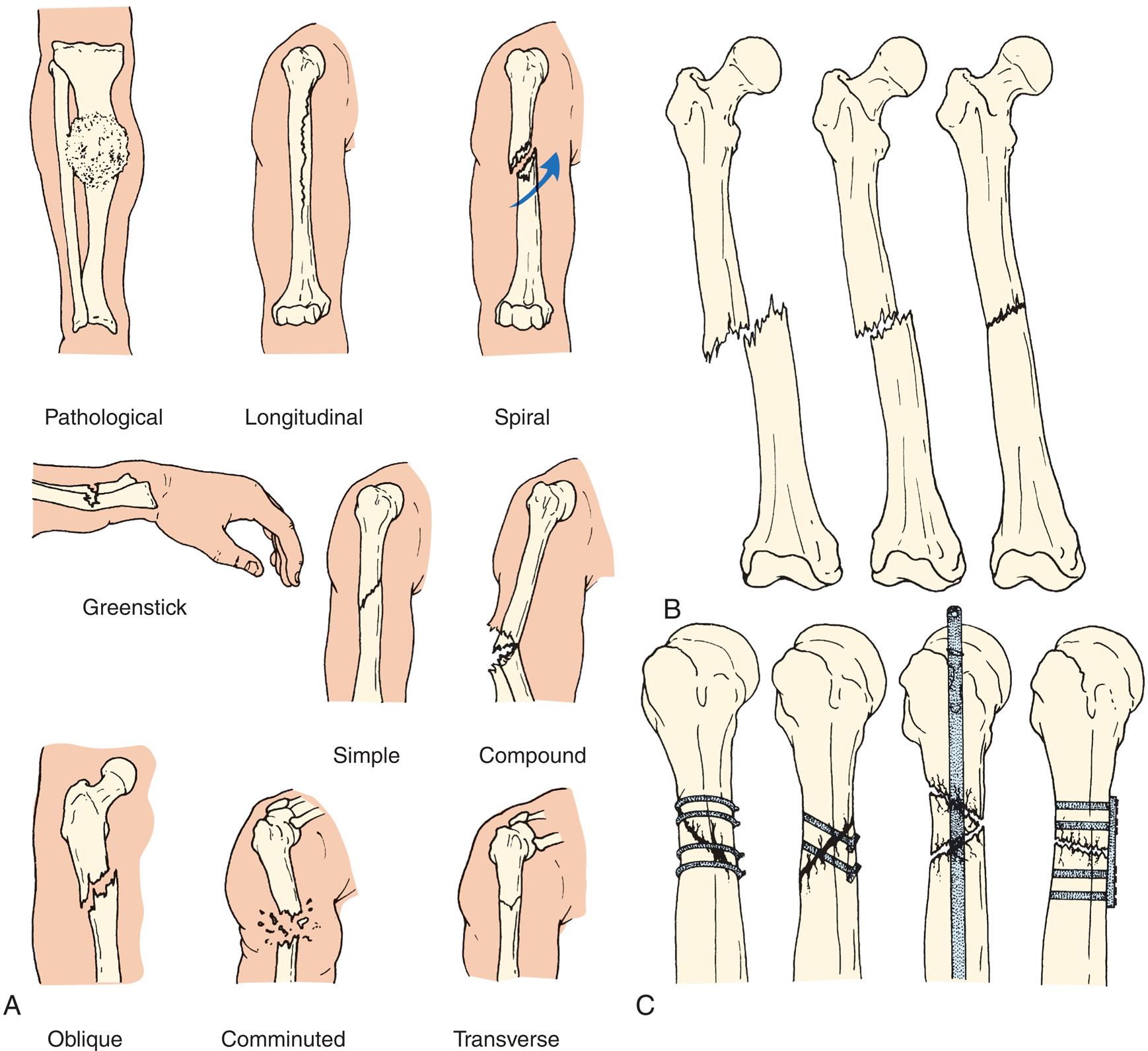A) A series of illustrations shows types of fractures as follows: Pathological, longitudinal, spiral, greenstick, simple, compound, oblique, comminuted, and transverse. B) A series of three bones shows partial healing of fracture. C) Four illustration of bones with fractured sites fastened using plates, screws, and stitches.
