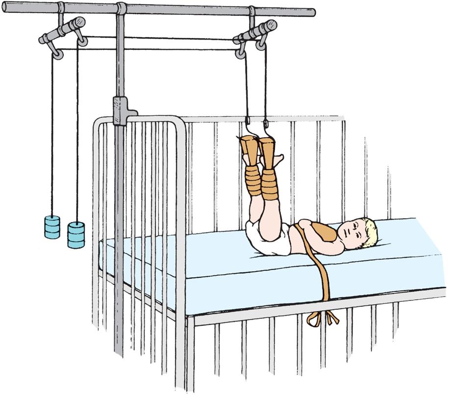 Illustration shows legs of young child elevated using Bryant’s traction. The child lies on hospital bed.