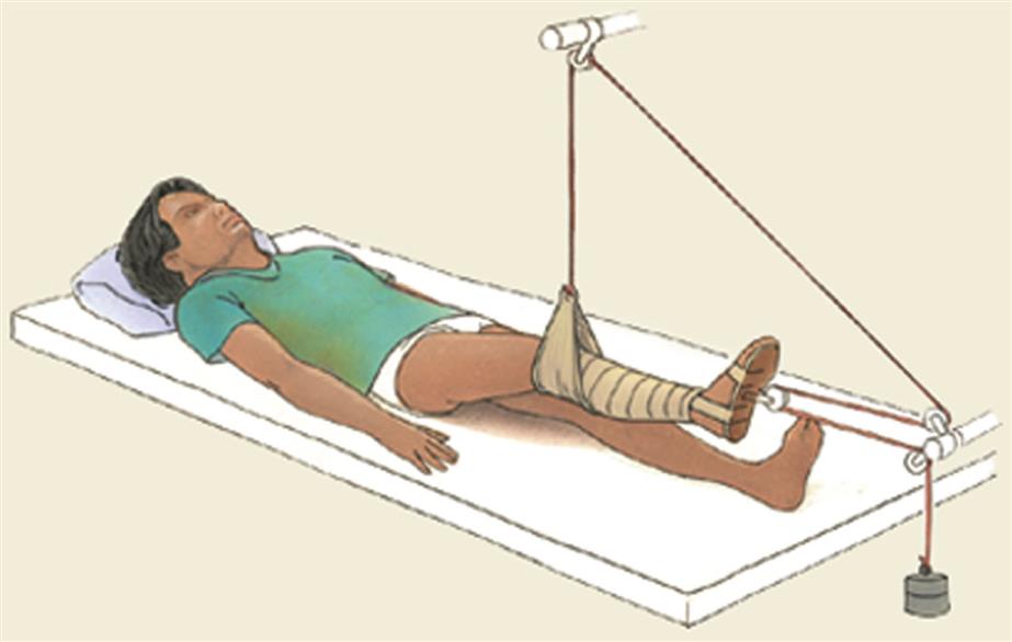 Close-up of a child lying on mattress while one leg is slightly elevated using Russell skin traction. A sling supports lower leg just below the knee.