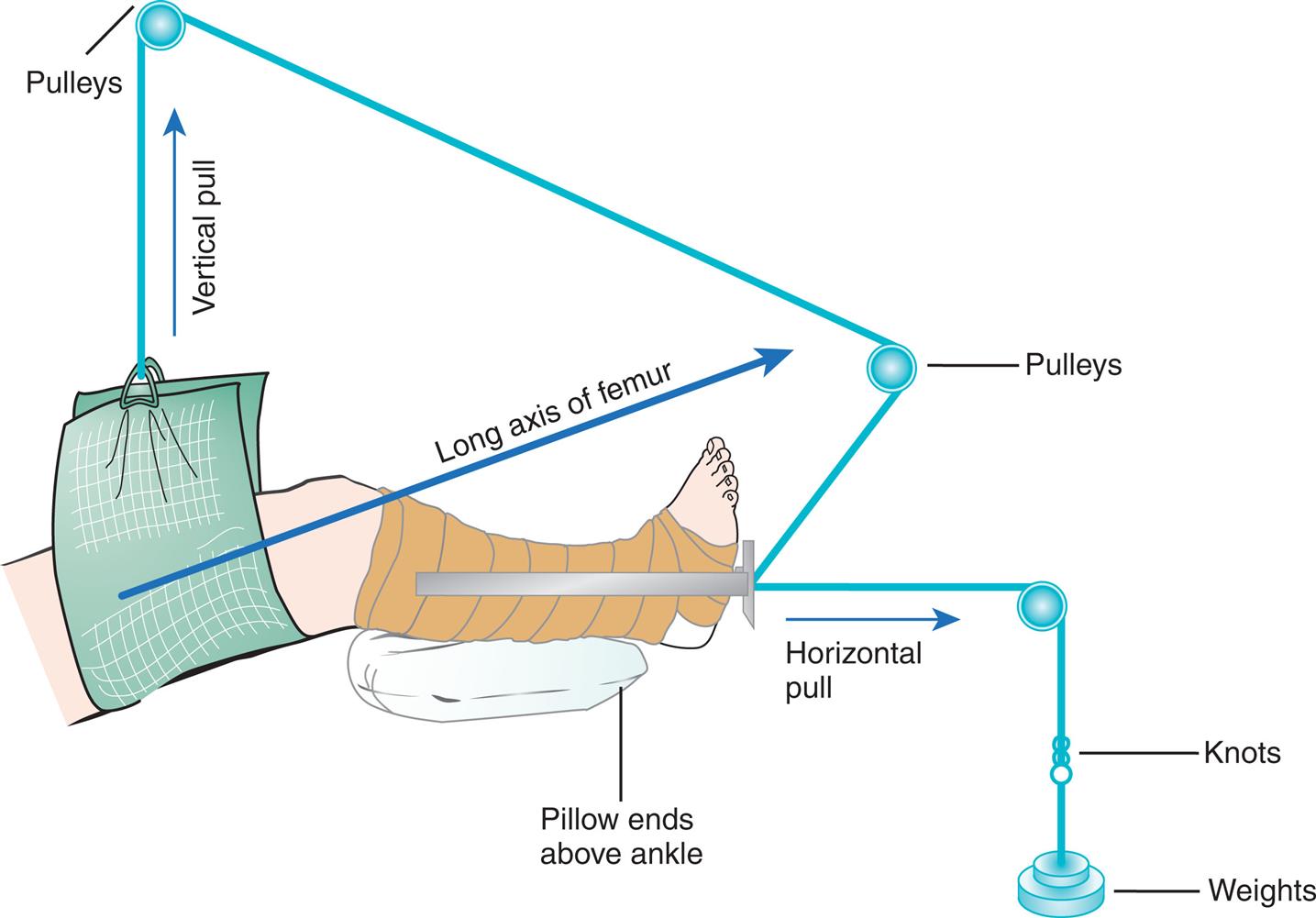 Illustration shows thigh being pulled upward by a vertical pull and pulleys. A diagonal arrow is marked long axis of femur. Lower leg has pillow ends above ankle and horizontal pull experienced using knots and weights.
