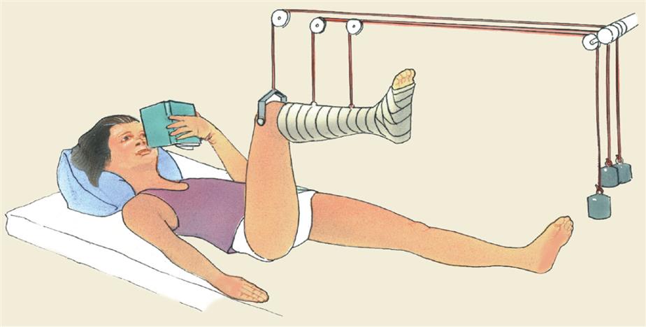 Illustration shows a young child lying on a bed with a book in hand. One leg is flexed at knee and elevated using skeletal traction. The lower leg and foot are supported in a boot cast.