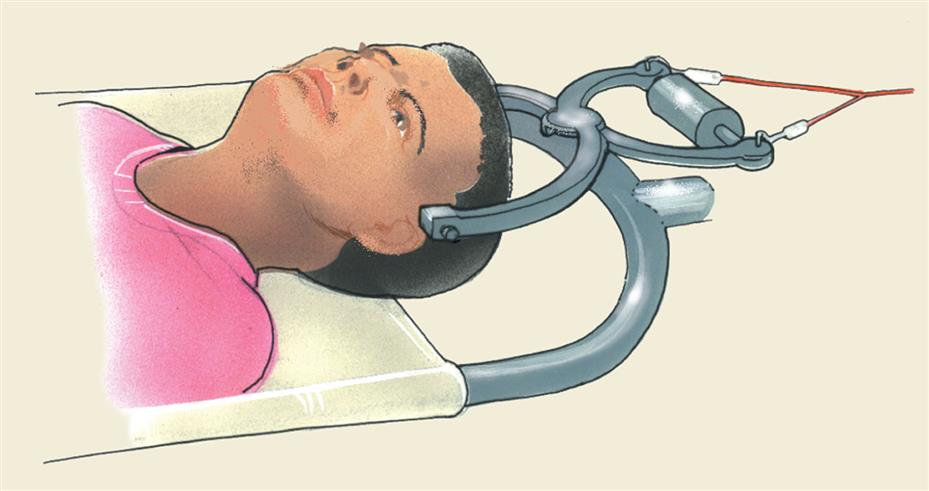 Illustration shows a head held in a cervical traction.