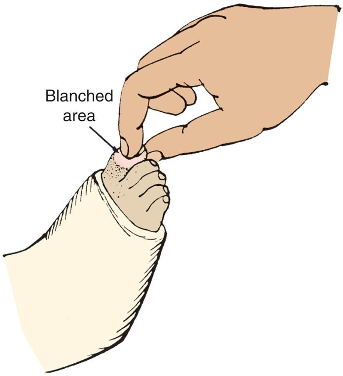 Illustration shows a foot in boot cast with toes exposed. A hand holds the big toe, marked blanched area.