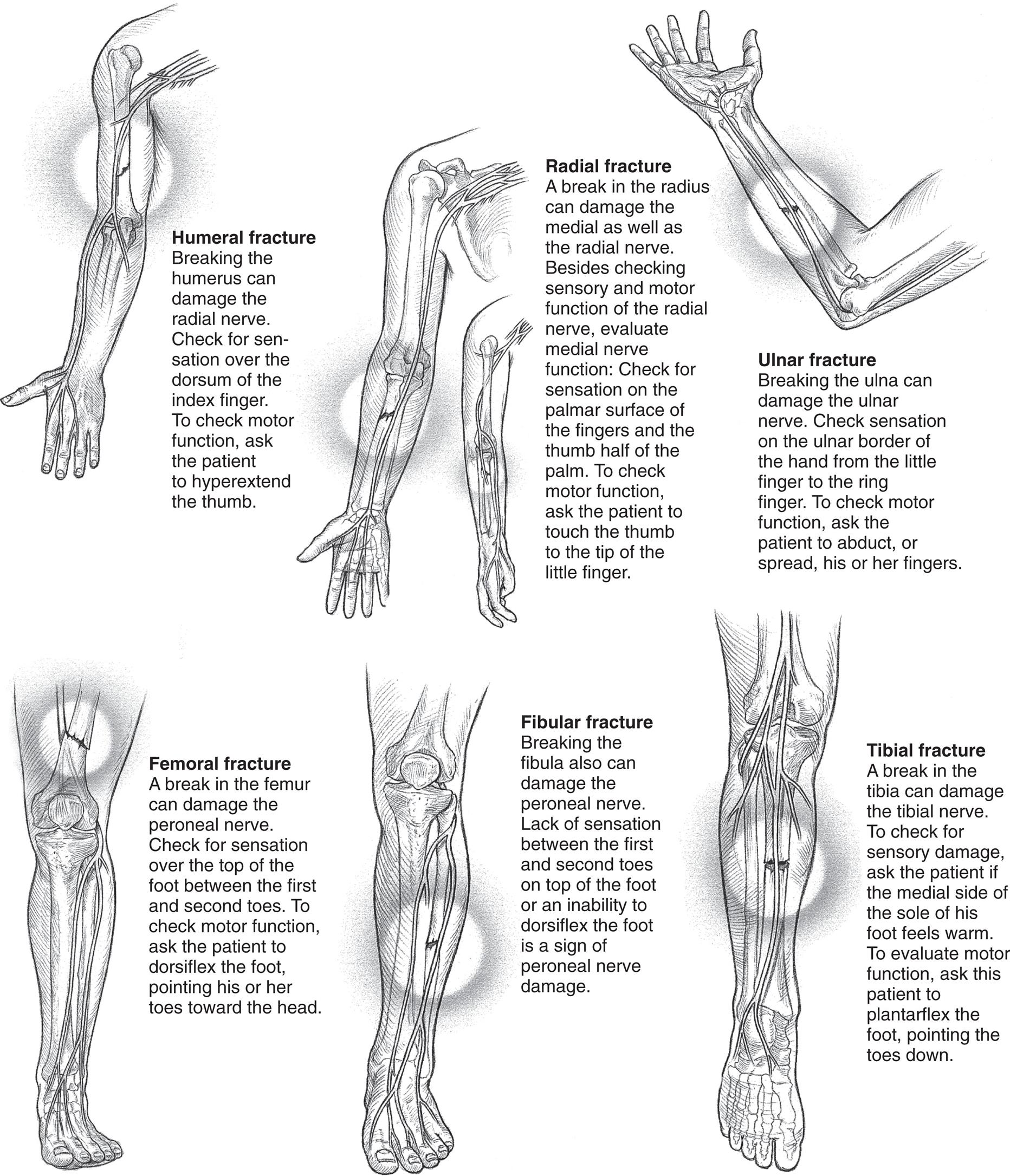 Illustrations of different bones with fractures are as follows: • Humeral fracture: Breaking the humerus can damage the radial nerve. Check for sen sation over the dorsum of the index finger. To check motor function, ask the patient to hyperextend the thumb. • Radial fracture: A break in the radius can damage the medial as well as the radial nerve. Besides checking sensory and motor function of the radial nerve, evaluate medial nerve function: Check for sensation on the palmar surface of the fingers and the thumb half of the palm. To check motor function, ask the patient to touch the thumb to the tip of the little finger. • Ulnar fracture: Breaking the ulna can damage the ulnar nerve. Check sensation on the ulnar border of the hand from the little finger to the ring finger. To check motor function, ask the patient to abduct, or spread, his or her fingers. • Femoral fracture: A break in the femur can damage the peroneal nerve. Check for sensation over the top of the foot between the first and second toes. To check motor function, ask the patient to dorsiflex the foot, pointing his or her toes toward the head. • Fibular fracture: Breaking the fibula also can damage the peroneal nerve. Lack of sensation between the first and second toes on top of the foot or an inability to dorsiflex the foot is a sign of peroneal nerve damage. • Tibial fracture: A break in the tibia can damage the tibial nerve. To check for sensory damage, ask the patient if the medial side of the sole of his foot feels warm. To evaluate motor function, ask this patient to plantarflex the foot, pointing the toes down.