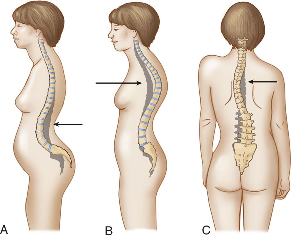Three illustrations show the abnormal curvatures of the spine. A) A lateral view of the spine with an arrow pointing to deeper than normal anterior curve of the lumbar vertebrae. B) A lateral view of the spine with an arrow pointing to deeper than normal posterior curve of the thoracic vertebrae. C) A posterior view of the spine with an arrow pointing to an excessive lateral curve to the right.