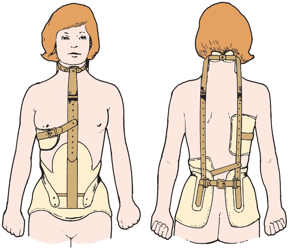 Illustration shows anterior and posterior view of young girl wearing brace that consists of neck ring and pad around abdomen and hips.
