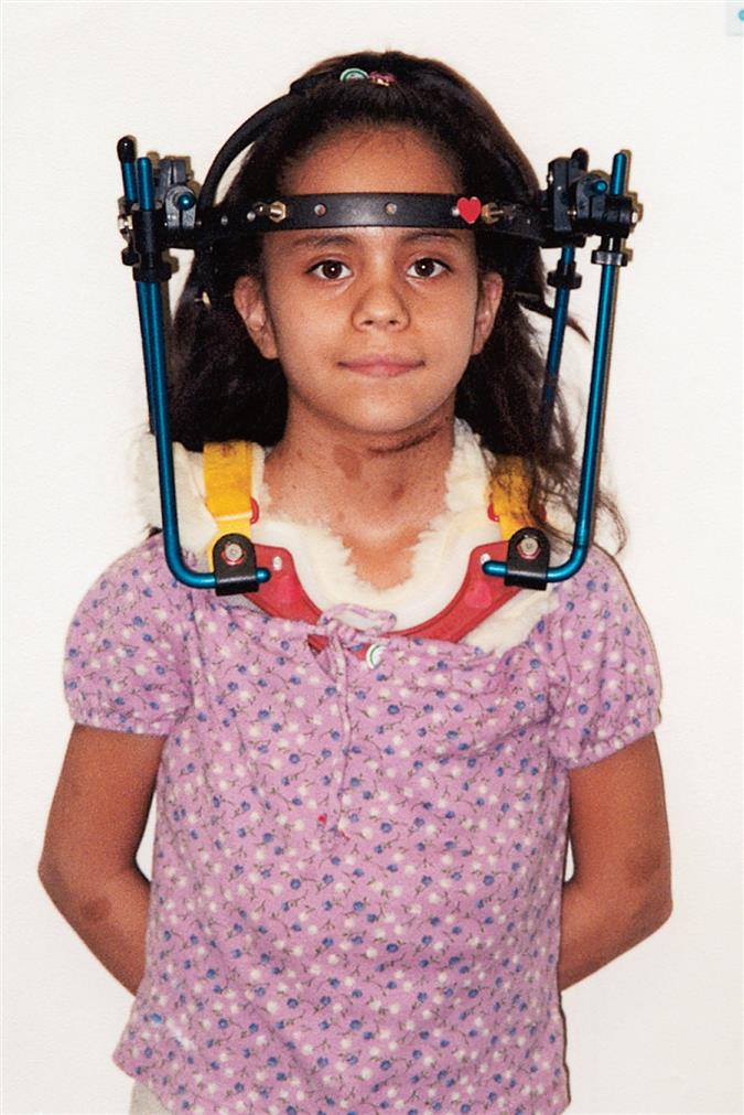 A child with a halo vest with a steel or iron halo attached to the head by 6 to 8 screws inserted into the outer skull and rigid bars on both sides are connecting halo to the vest worn around the chest.