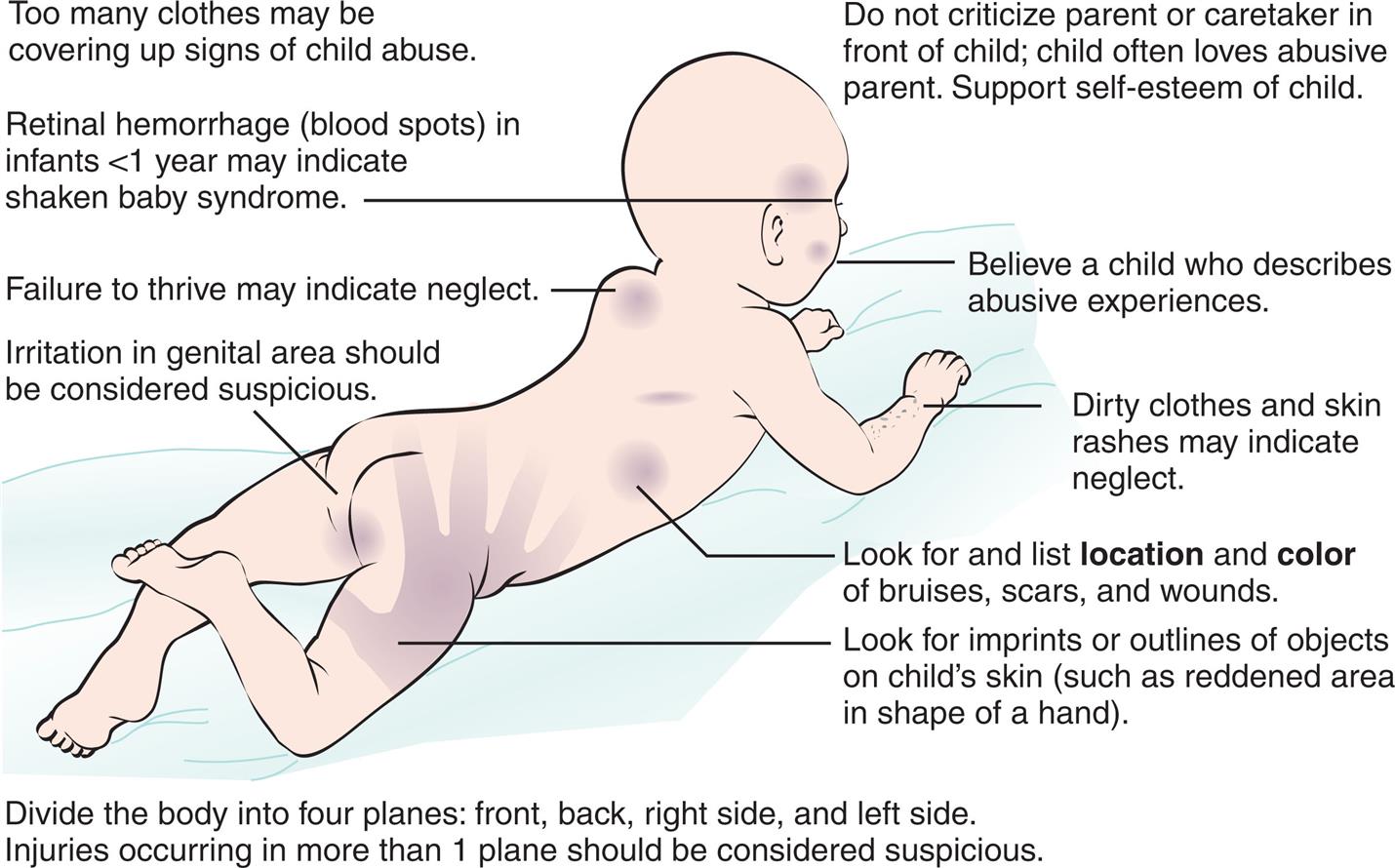 The following should be addressed while assessing for child abuse: • Too many clothes may be covering up signs of child abuse. • Do not criticize parent or caretaker in front of child; child often loves abusive parent. Support self-esteem of child. • Divide the body into four planes: front, back, right side, and left side. Injuries occurring in less than one plane should be considered suspicious. Illustration of an infant with marks on the body is labeled clockwise as: believe a child who describes abusive experience, dirty clothes and skin rashes may indicate neglect, look for and list location and color of bruises, scars, and wounds, look for imprints or outlines of objects on child’s skin (such as reddened area in shape of a hand), irritation in genital area should be considered suspicious, failure to thrive may indicate neglect, and retinal hemorrhage (blood spots) in infants less than one year may indicate shaken baby syndrome.