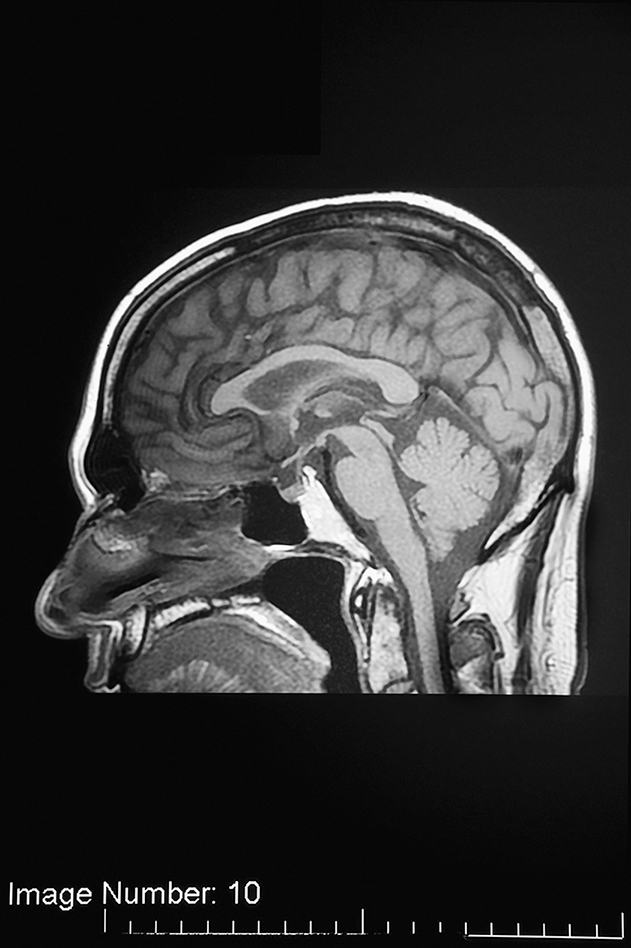 A midline post-contrast M R I scan of the brain on a sagittal plane.