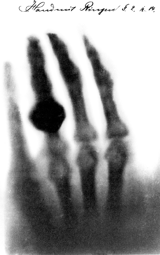 An x-ray image of a hand shows an object on the ring finger.