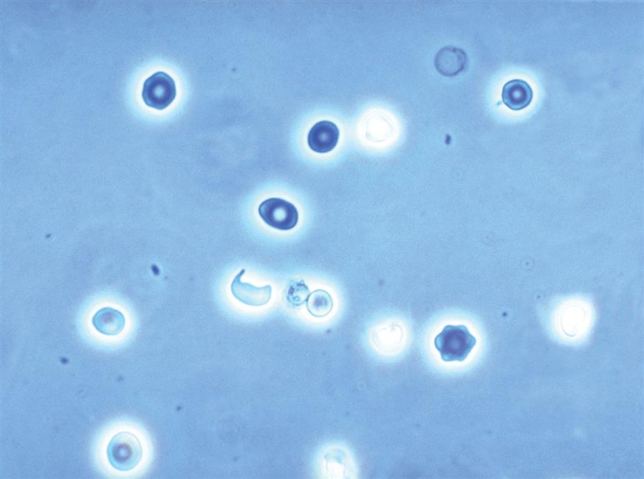 7: Routine Urinalysis–the Microscopic Exam of Urine Sediment