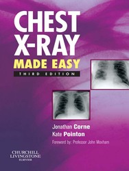 Chest X-Ray Made Easy, 3E