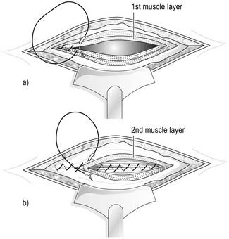 Munro Kerr's Operative Obstetrics