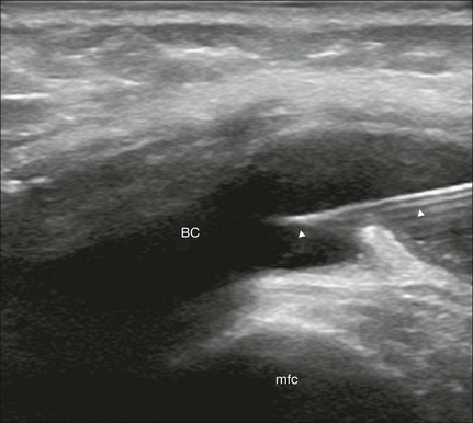 Aspiration and injection of joints and periarticular tissue and ...