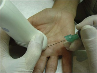 Aspiration and injection of joints and periarticular tissue and ...