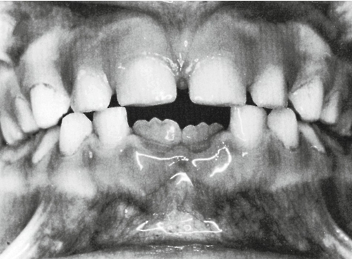 Wheeler’S Dental Anatomy, Physiology, and Occlusion