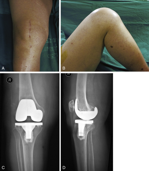 Techniques in Revision Hip and Knee Arthroplasty