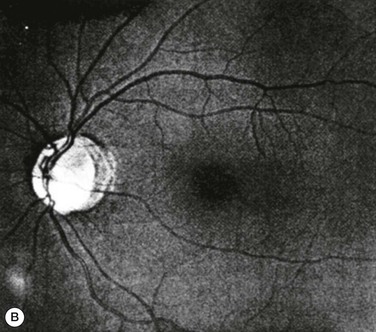 Retinal Nerve Fiber Layer (RNFL) Photography and Computer Analysis
