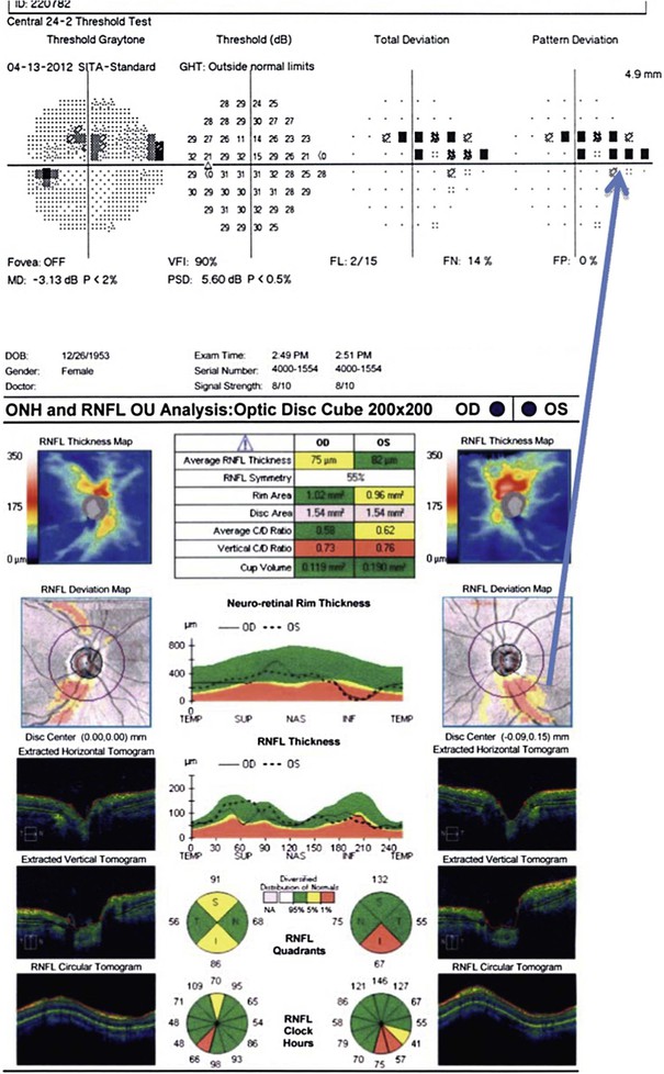 Retinal Nerve Fiber Layer (RNFL) Photography and Computer Analysis